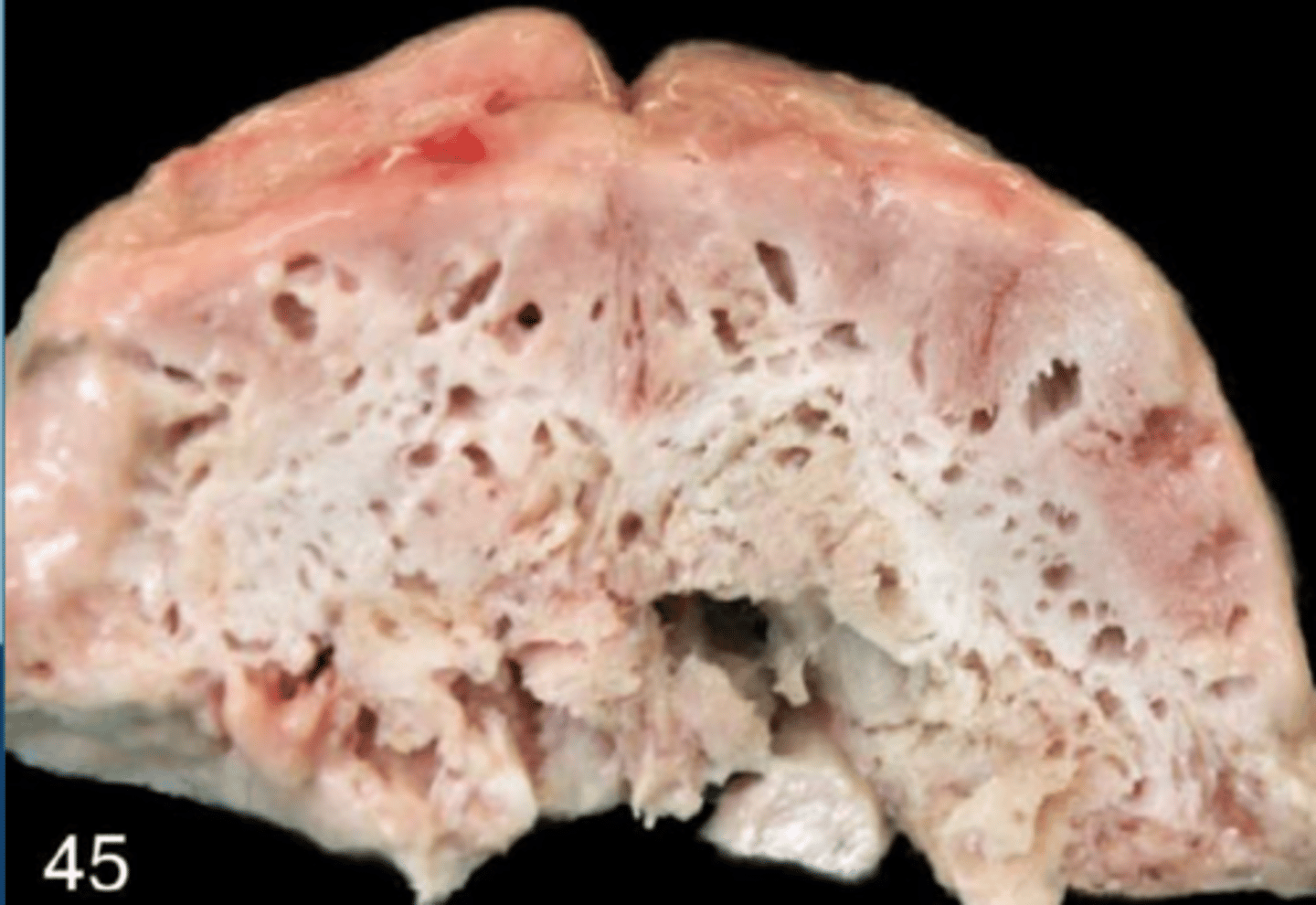 <p>what caused this "swiss cheese brain"?</p>