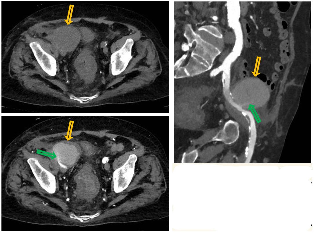 <p>Patient history: elderly patient with end-stage renal disease, transplant kidney removal surgery a few hours before, large hematoma on US </p><p>Modality: left upper and lower images – non-enhanced abdomen and pelvis CT and CTA, axial plane, soft tissue window (iv. iodine-based contrast agent); right – CTA MPR (multiplanar reconstruction) </p><p>Region: pelvis </p><p>Radiologic sign: Mass along the right external iliac artery with an approximate noncontrast density of 25 HU, the density measured on CTA is around 100 HU. As seen on CTA, the contrast agent is flowing into the lesion in a narrow lane (green arrow). </p><p>Diagnosis: post-surgical right external iliac artery pseudoaneurysm</p>