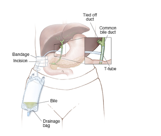 <p><span style="color: blue"><strong>closed, passive drain </strong></span><strong>used to stent and drain the common bile duct after choledochotomy </strong></p>