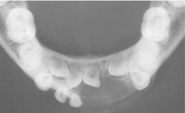 <p>Occlusal radiograph</p>