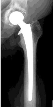 <p>Operative Frakturbehandlung</p><p><strong>Endoprothese</strong></p><ul><li><p>völlig zerstörtes Gelenk</p></li><li><p>nicht erhaltene Knochendurchblutung</p></li><li><p>in der Regel großes Gelenk (Oberarmkopf, Ellenbogen, Hüfte, Knie, Sprunggelenk)</p></li><li><p>evlt in Verbindung mit Knochenzement</p></li><li><p>Teil- oder Totalersatz</p></li></ul><p></p>