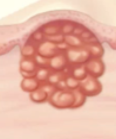 <p>Primary Skin Lesion</p><ul><li><p><strong>Solid</strong> mass of <strong>0.5-2 cm</strong> with <strong>circumscribed border</strong> <strong>under dermis</strong></p></li><li><p>E.g. lipoma</p></li></ul><p></p>