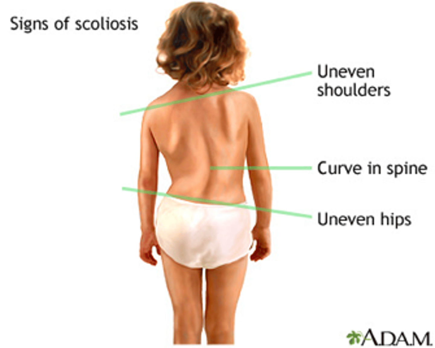 <p>•Visible deformity of spine with +/- uneven shoulder and/or pelvic height</p><p>•Often picked up during school screening. Adams forward bending test >7 degrees on scoliometer</p><p>•Hairy patches on back or cafe-au-lait spots&nbsp; (neurofibromatosis)</p><p>•Respiratory restriction in severe cases (PFT)</p>