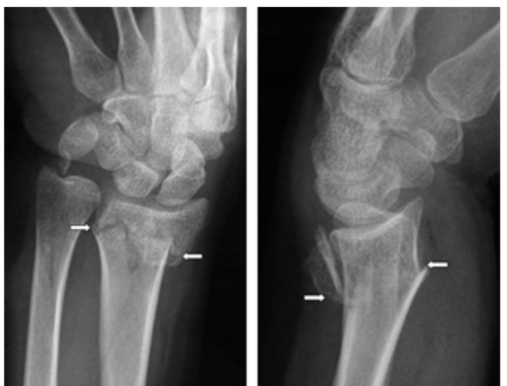 1. Typically fracture distal radius while catching yourself during a fall 
2. Common in older females
3. “Dinner-fork ” presentation
4. Can lead to nerve damage and dysfunction
