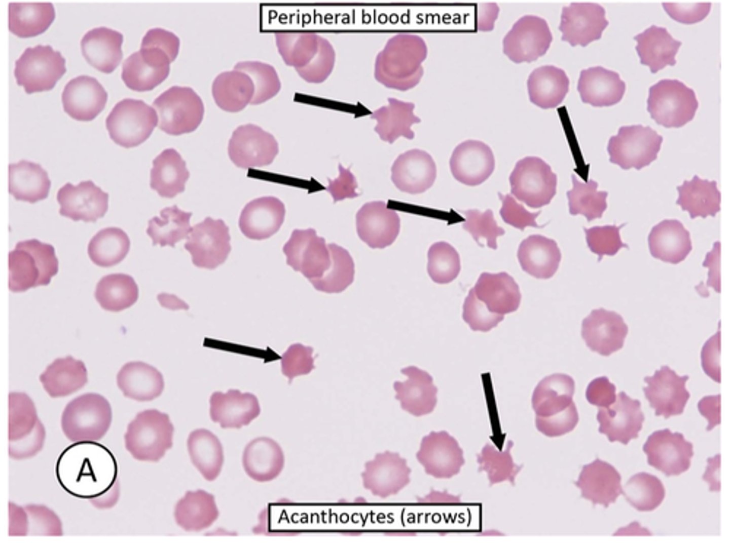 <p>-acanthocytes are RBCs with irregularly sized and spaced projections that are most commonly seens in liver disease</p>