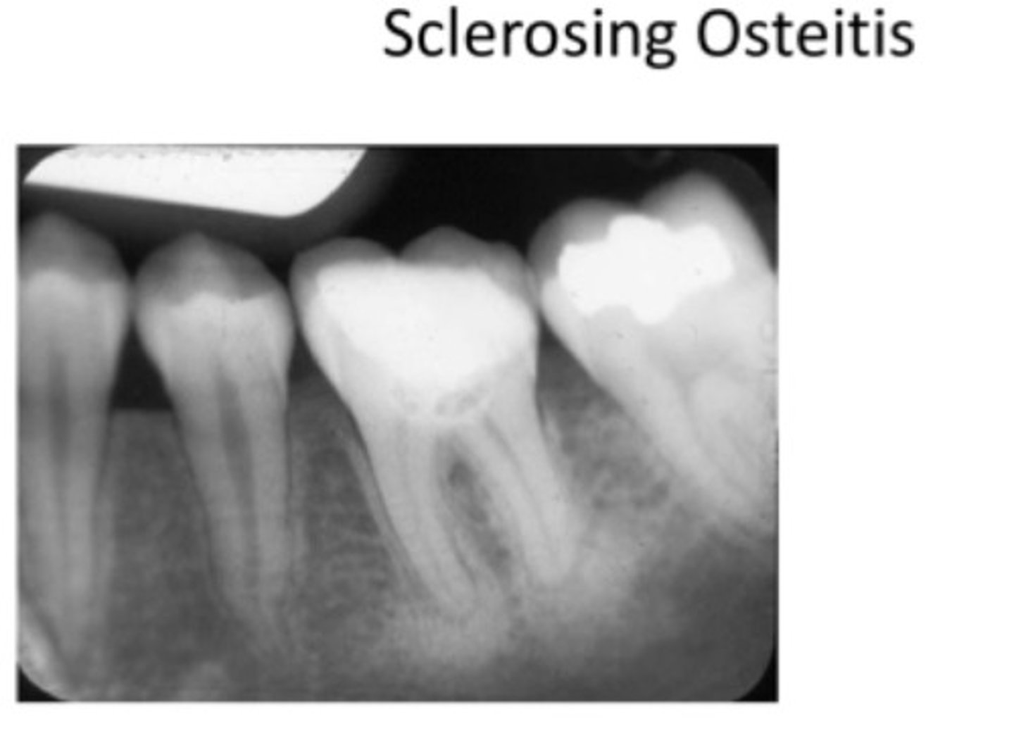 <p>Condensing osteitis</p>