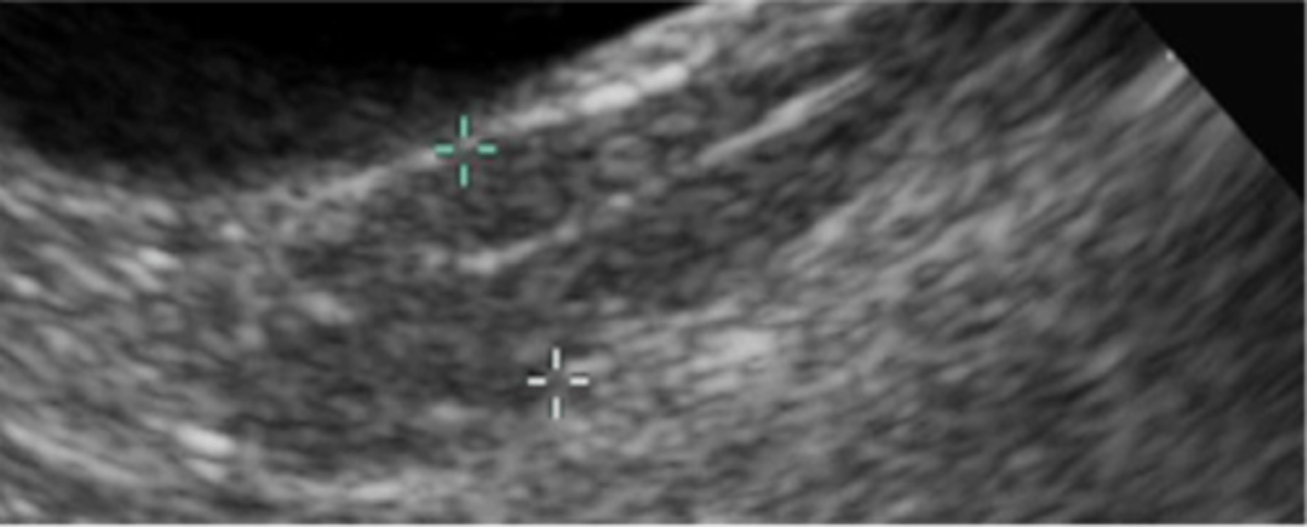 <p>Tubular structure dorsal to the urinary bladder</p><p>Echogenic line in the middle (collapsed lumen, mucus)</p><p>Distended if in heat or with pathology (pyometra)</p>