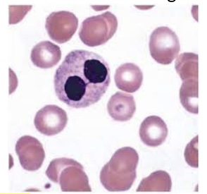 <p><span style="font-family: Helvetica; font-size: 12px;">The disease most closely associated with the granulocytic morphology shown here is:</span></p>