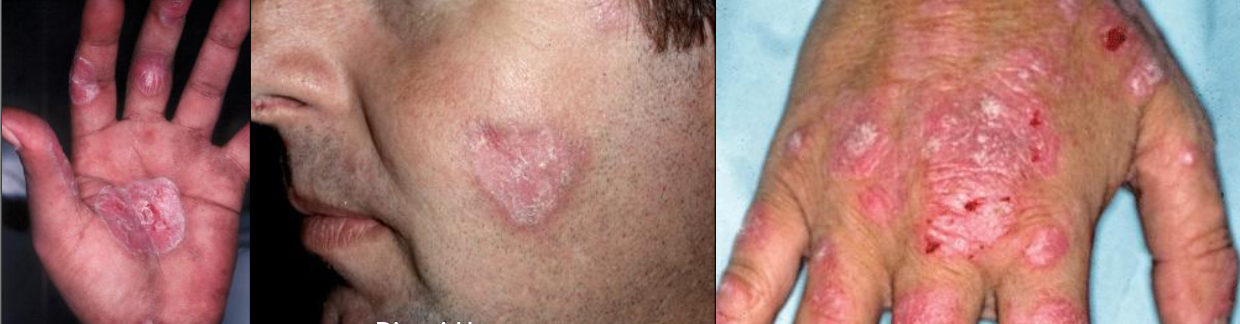 <ul><li><p><strong>Discoid lupus erythematosus:</strong> Scaly, erythematous patches on sun exposed areas</p></li><li><p><strong>Scar and hypopigmentation</strong></p></li></ul><p></p>