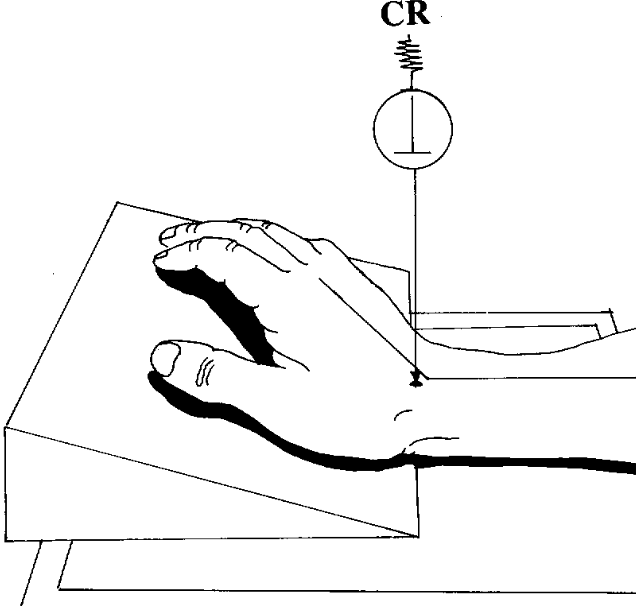 <p>true stretchers (wrist)</p><ul><li><p>hand elevated </p></li></ul><p></p>