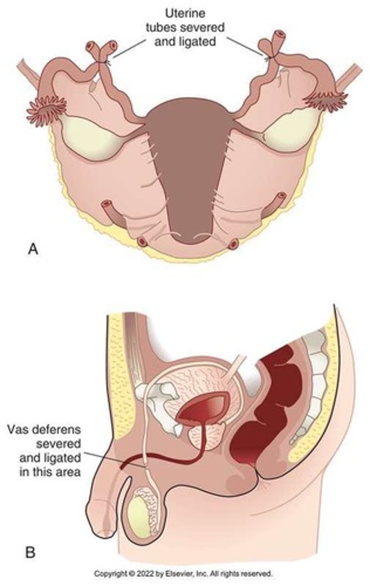 <p>Female sterilization (tubal occlusion) and male sterilization (vasectomy).</p>