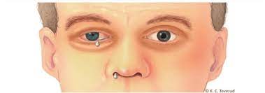 <ul><li><p>+ homens (20-40 anos)</p></li><li><p>dor intensa unilateral supraorbitária e/ou temporal → dura horas/dias</p></li><li><p>padrão ciclico</p></li><li><p><u>sinais autonómicos </u>(ipsilaterais): ptose, rinorreia, hiperemia conjuntival, lacrimejo</p></li><li><p>inquietação, freq. à noite</p></li></ul><p></p>