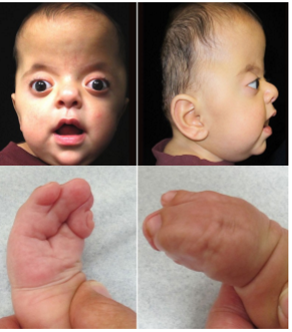 <ol><li><p>flat elongated forehead </p></li><li><p><u>proptosis </u></p></li><li><p>underdeveloped midface </p></li><li><p><u>fusion of the digits </u></p></li></ol><p></p><p>brachycephaly and/or oxycephaly </p><p></p>