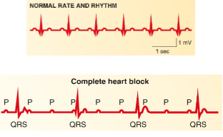 **→ Loss of synchronization between atria and ventricles (P is firing but QRS isn’t)**