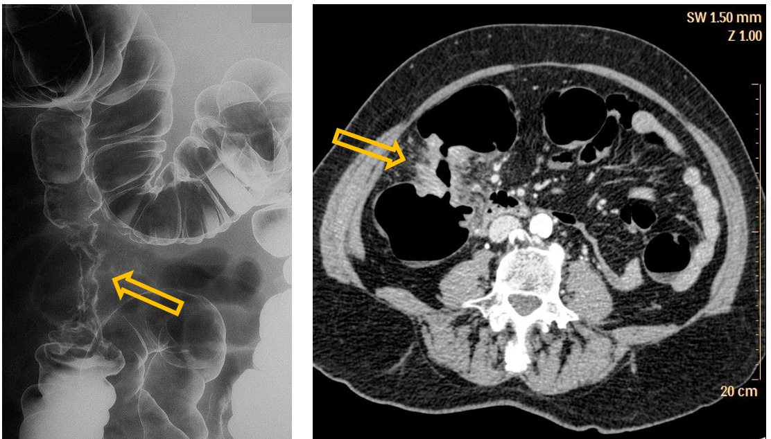 <p>Patient history: change in bowel habits and weight loss </p><p>Modality: left - Barium enema study, double-contrast method (barium and air); right – contrast-enhanced CT, venous phase, iv. iodine-based contrast agent </p><p>Region: Abdomen, axial view </p><p>Radiologic sign: Annular irregular stenosis and bowel wall thickening (apple-core sign), tumorous infiltration of the surrounding fat (increased density) </p><p>Diagnosis: colon adenocarcinoma</p>