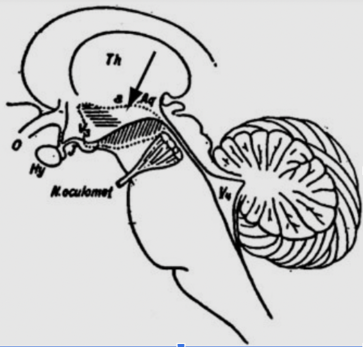<p>Von Economo's Inferences</p><p>(dotted lines)</p><p>*Diagonal hatching = hypersomnolence</p><p>*Horizontal hatching = insomnia</p><p>*Lesions at the arrow induce narcolepsy</p><p>These findings suggested to Von Economo that these two areas were the neural circuitry of sleep and wakefulness</p><p>Von Economo learned that there are two ares responsible for the neural circuitry of sleep and wakefulness. Lesion to one area lead to hypersomnolence and lesion to another area lead to insomnia. A lesion in between these sites leads to narcolepsy.- HLA (immune system maker), found in 100% of people with narcolepsy</p>