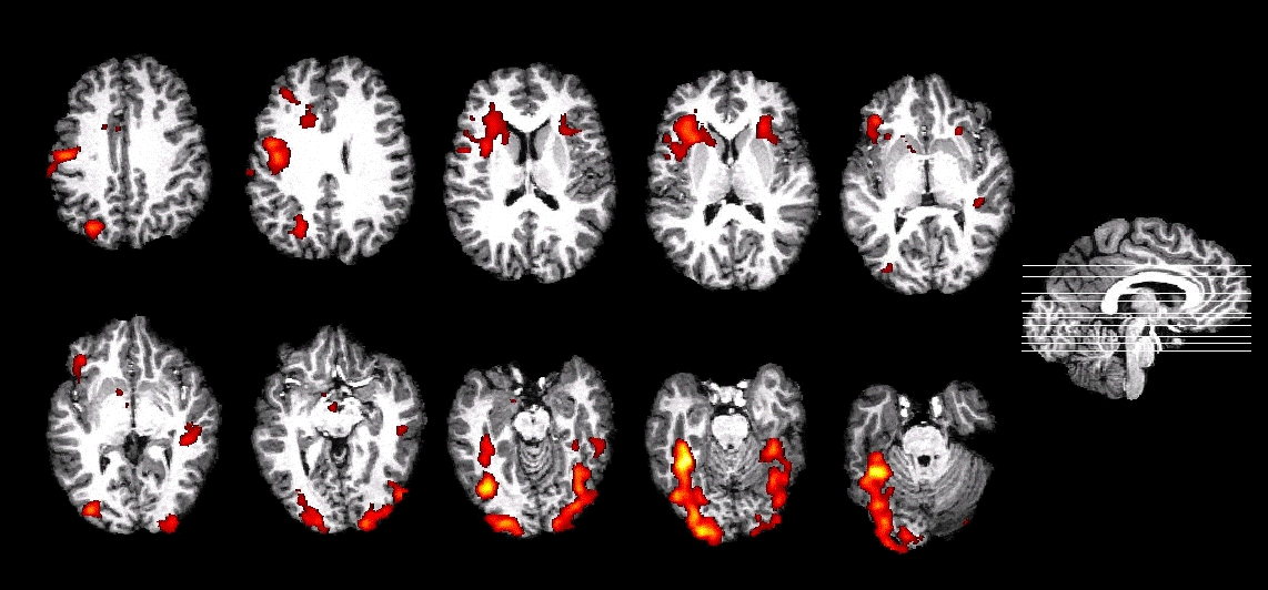 <p><strong>uses oxygen consumption</strong> in the brain to provide a moving and detailed picture; <strong>safer and less expensive than PET</strong></p>