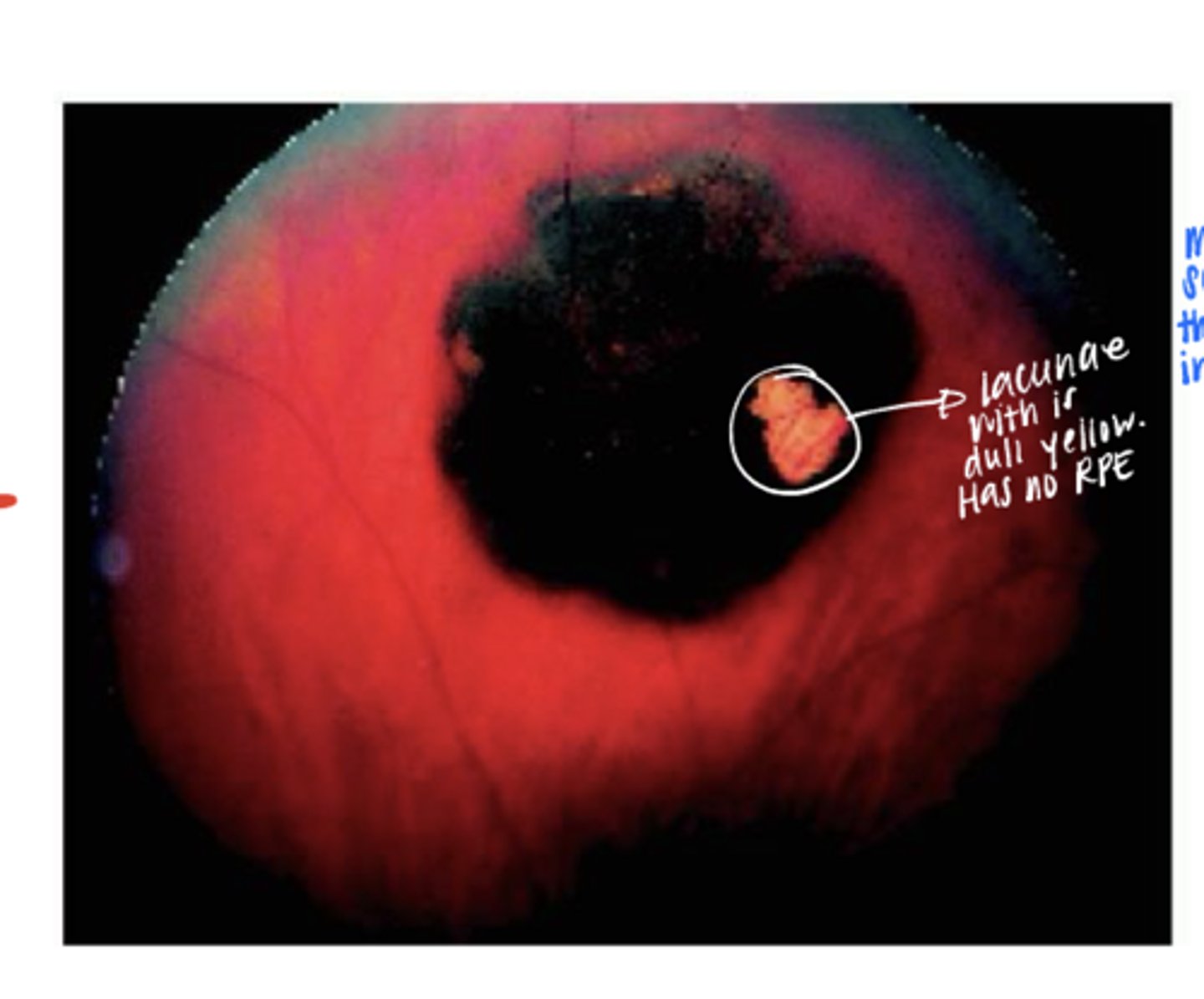 <p>What may appear with a Unifocal CHRPE?</p>
