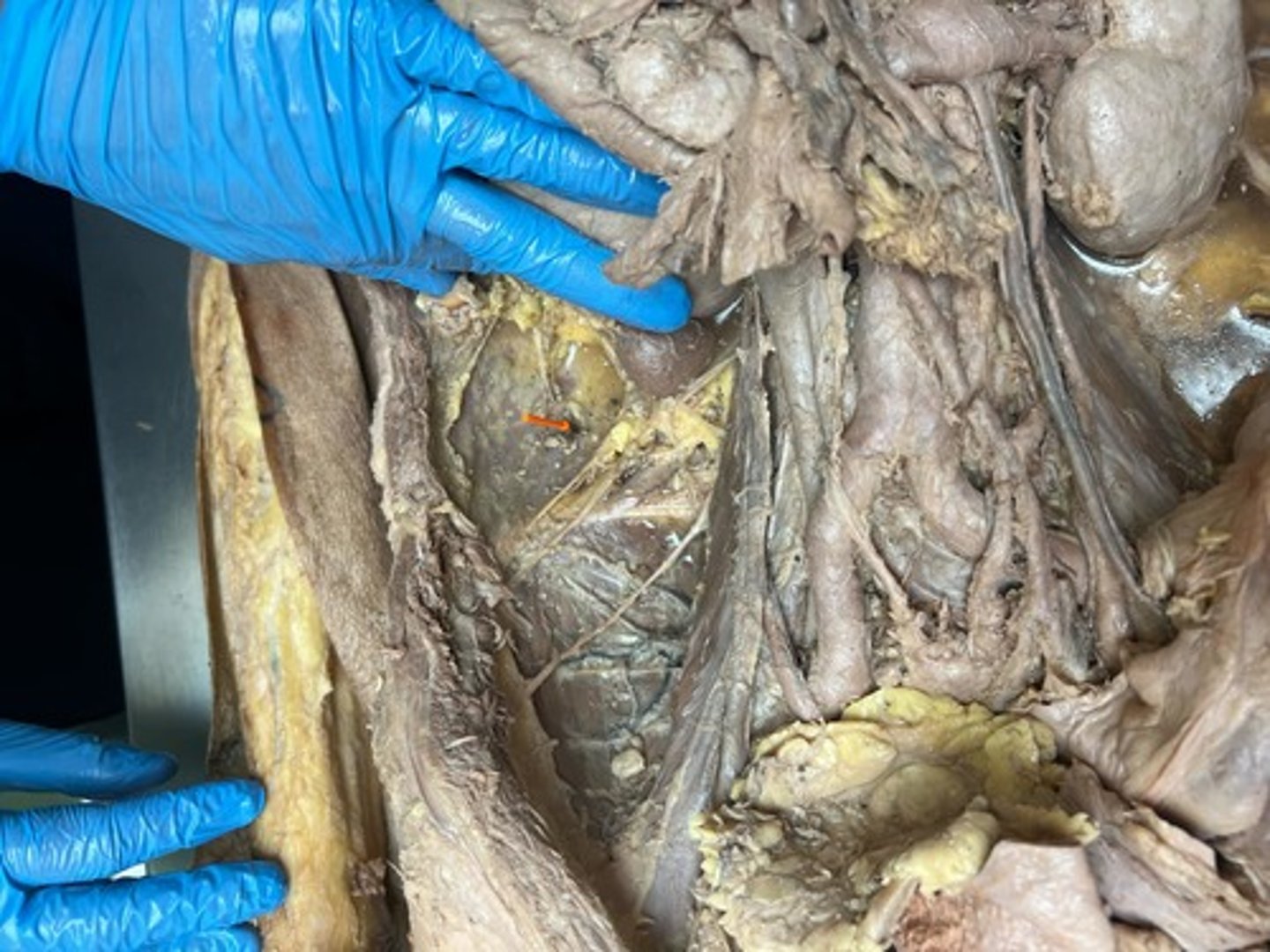 <p>quadratus lumborum muscle</p>