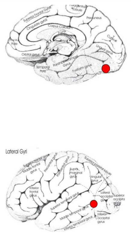 \- L’agnosie des couleurs : elle est rare, provient de la voie ventrale ; aire V4 (partie postérieure des gyrus lingual et fusiforme).
➢ (Hémi)achromatopsie : acuité visuelle, perception du mouvement, identification des objets préservées mais vision en nuances de gris (peut toucher un ou les deux hémichamps).
➢ Anomie des couleurs : les couleurs sont reconnues mais ne peuvent pas être nommées.
\- L’agnosie du mouvement : elle est très rare, elle provient de l’intermédiaire des voies ventrale-dorsale (entre le lobe occipital et le lobe temporal).
➢ Akinétopsie = vision des choses sans continuité, avec des images discrètes ; la perception de tout ce qui est en mouvement est perturbée. Le patient voit des scènes fixes.