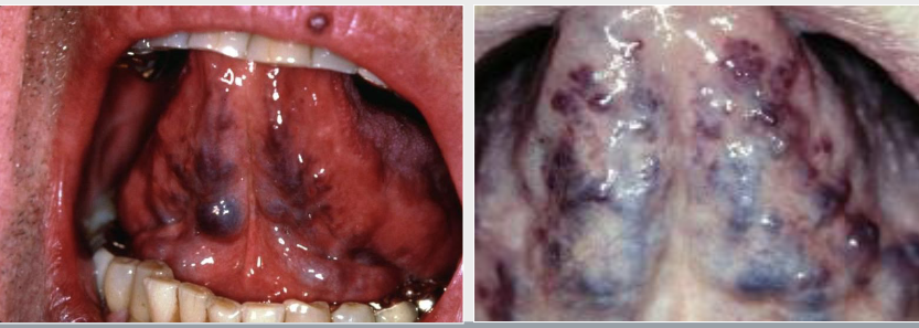 <p>Red-to-purple enlarged vessels or clusters</p>