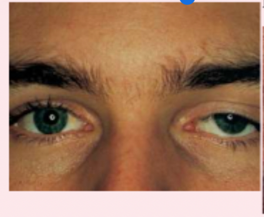 <p><span>Ptosis</span></p>