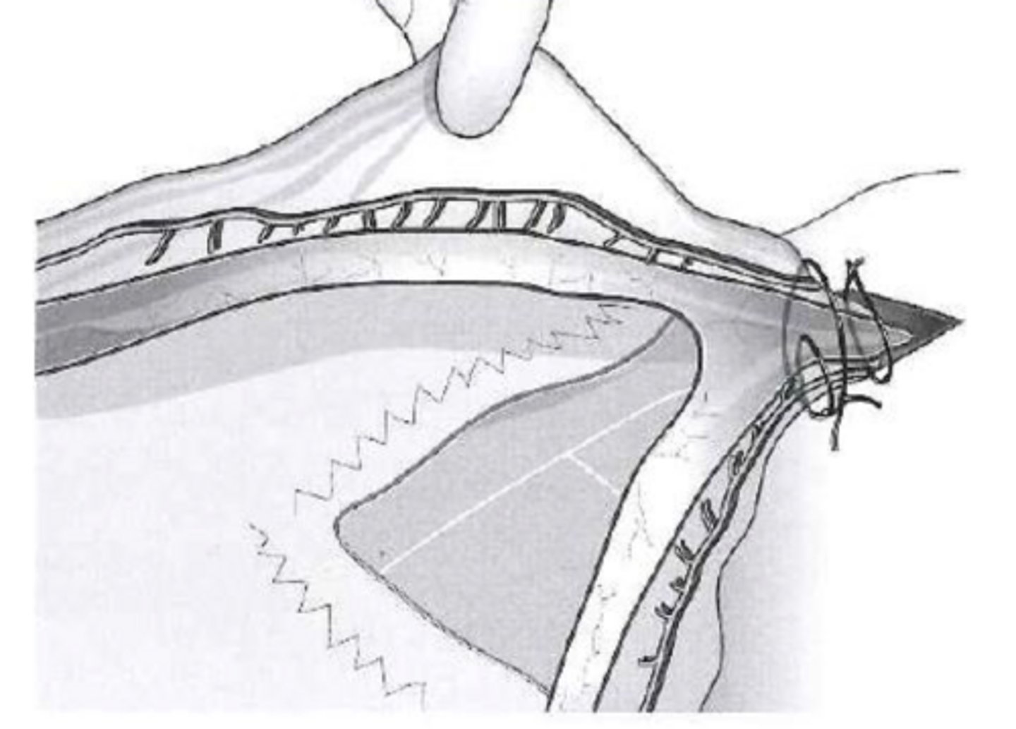 <p>specifics of ligating the uterus</p>