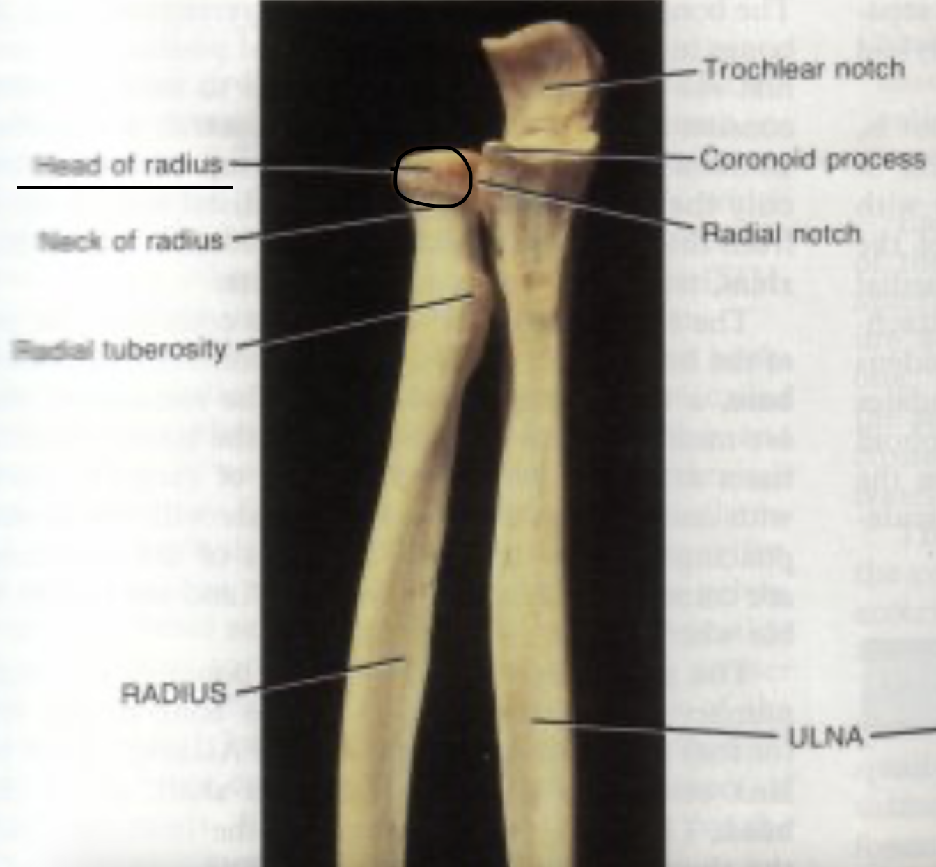 <p>head of the radius</p>