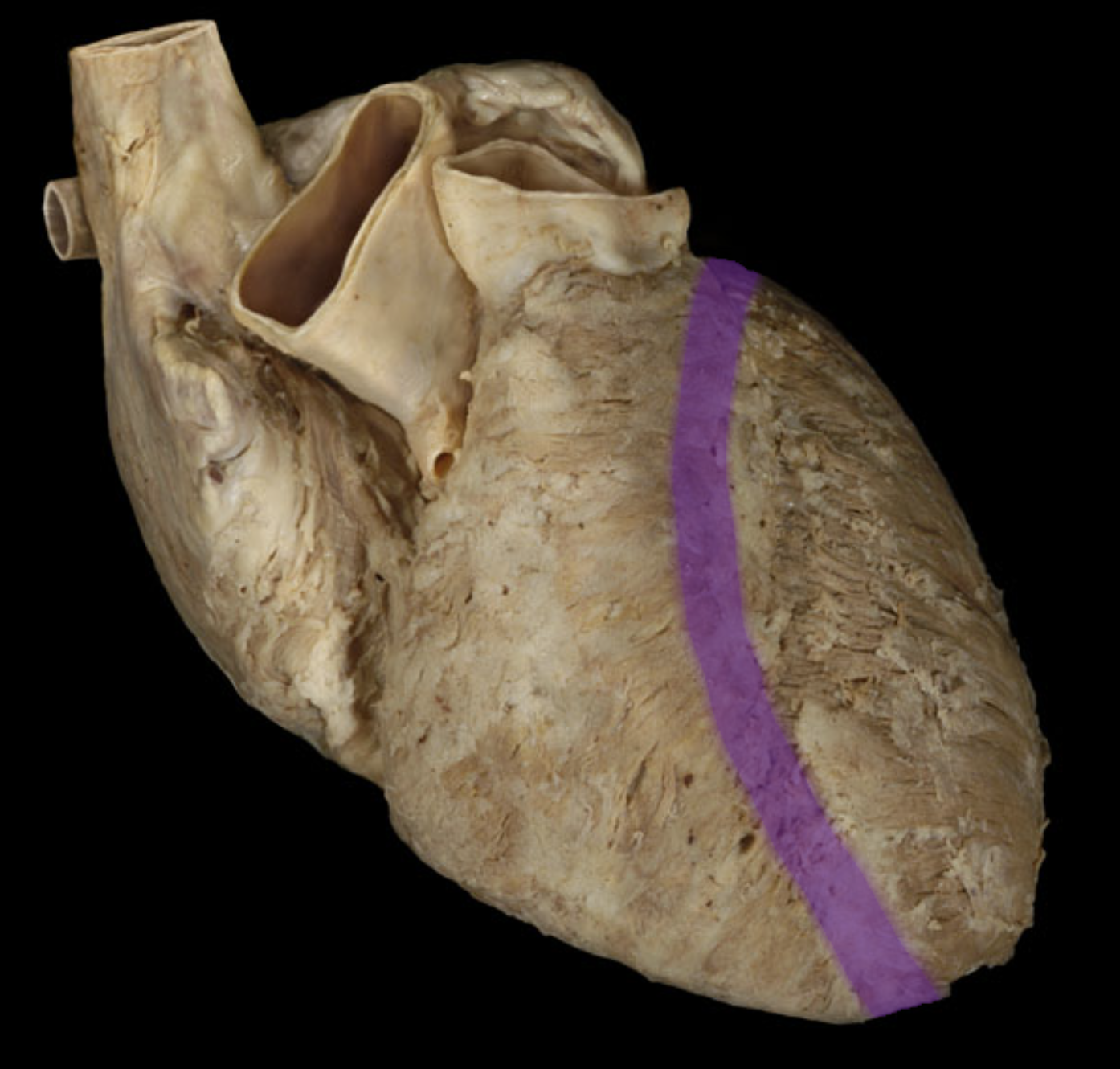 <p>Anterior inverventricular Sulcus </p>