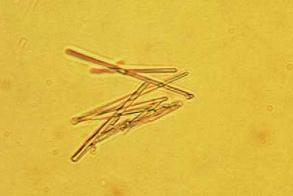 <ul><li><p class=""><strong>Normal finding</strong>, often seen after <strong>refrigeration</strong></p></li><li><p class="">Caused by <strong>protein-rich diet</strong></p></li><li><p class=""><strong>Not clinically significant</strong>; typically <strong>not reported</strong> if observed in specimens</p></li></ul><p></p>