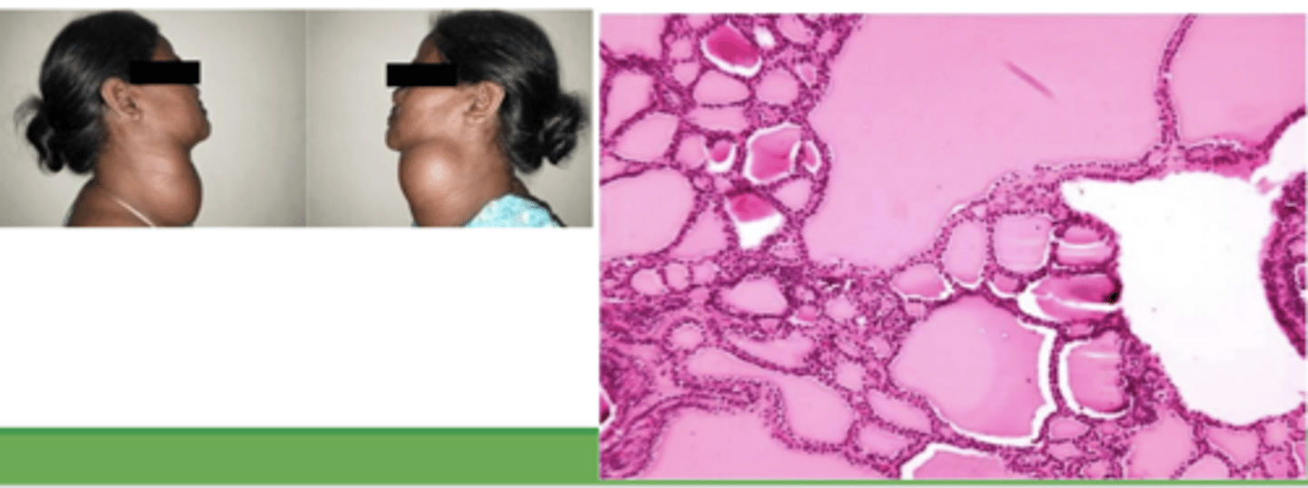 <p>A 47-year-old woman presents with a large, painless swelling of the neck that has rapidly increased in size over the last 2 years. She reports experiencing low moods, weight gain, cold intolerance, and breathlessness on exertion. What organ may be causing the problem, and explain?</p>
