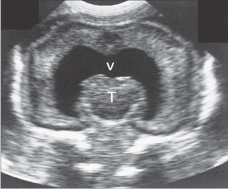<p>What is the structure labeled T?</p>