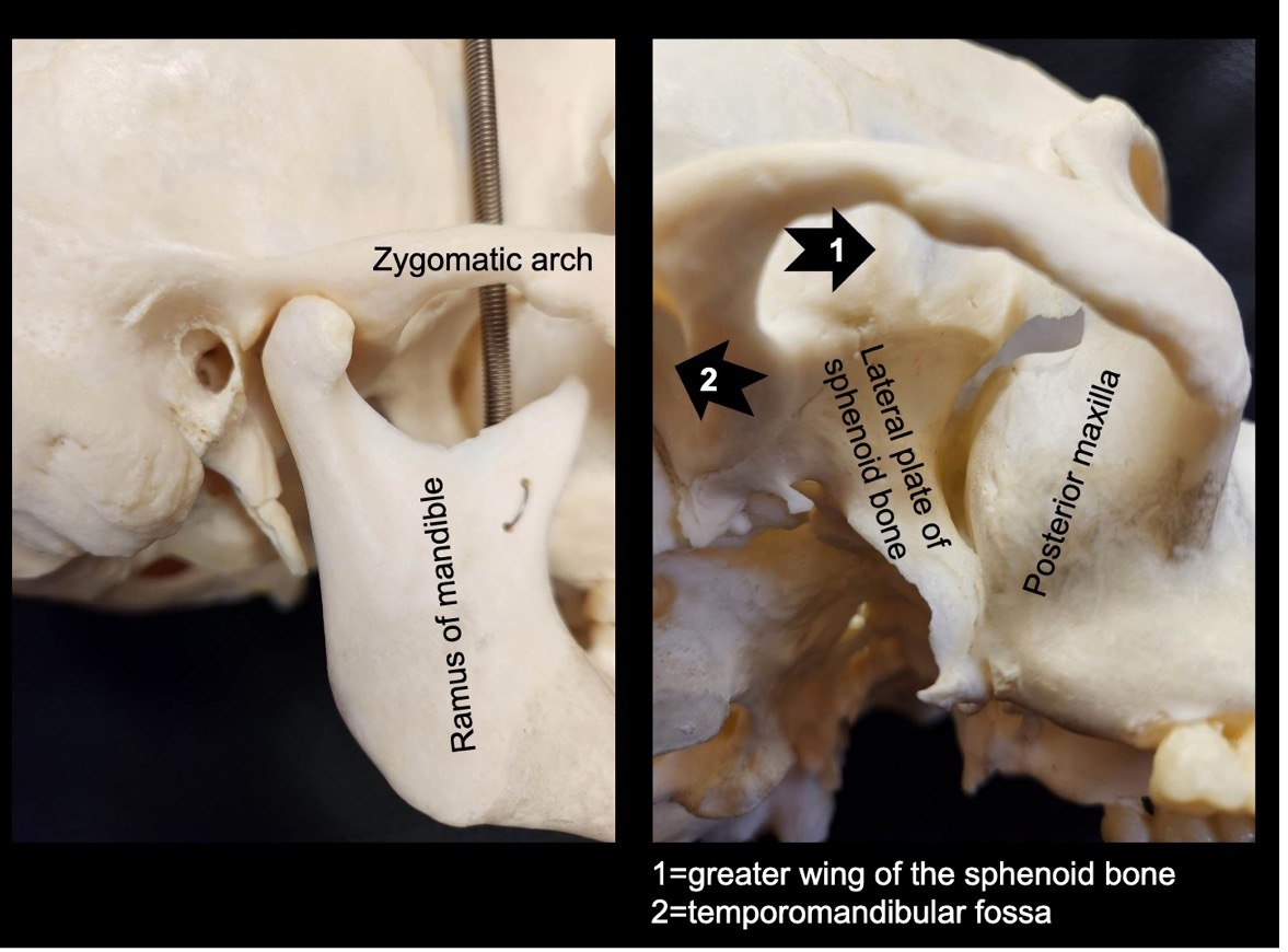 <p>*mandible removed in this image</p><p>*note the external auditory meatus (hole posterior to ramus of mandible)</p>