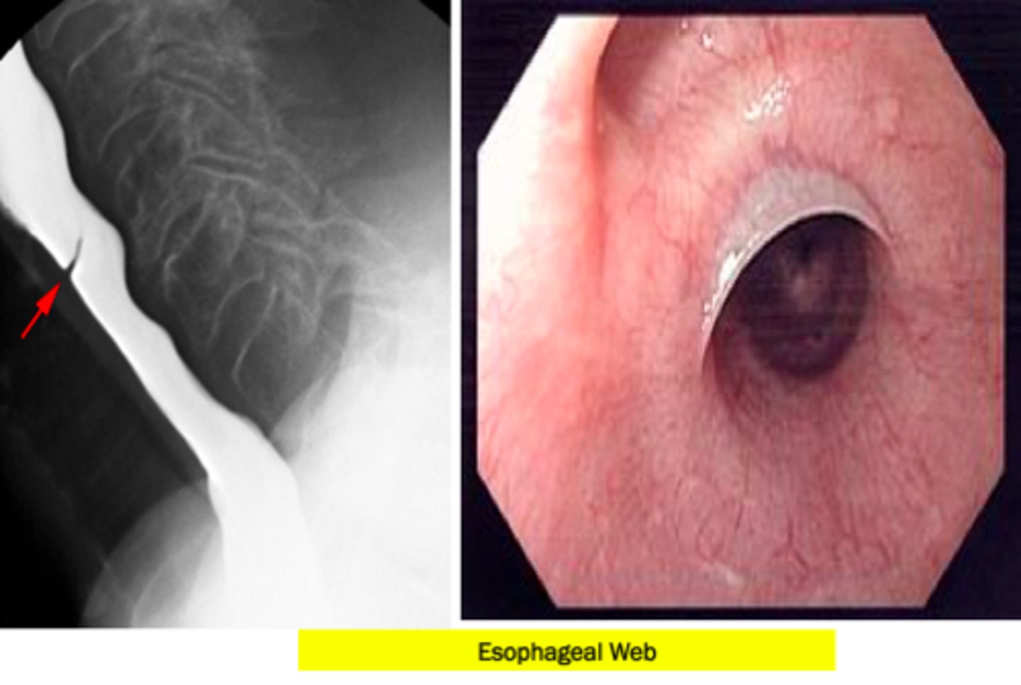<p>Esophageal dilation or electrosurgical incision and long term PPI therapy.</p><p>This patient has esophageal webs</p>