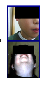 <p>Viral sailodentitis (epidemic parotitis)</p><p>Incubation period 2-3 weeks</p><p>Direct or droplet spread</p><p><strong><u>Features</u></strong></p><ul><li><p>Bilateral parotid swelling</p></li><li><p>Painful, malaise, fever</p></li><li><p>May spread to other glands or organs</p></li></ul><p></p>