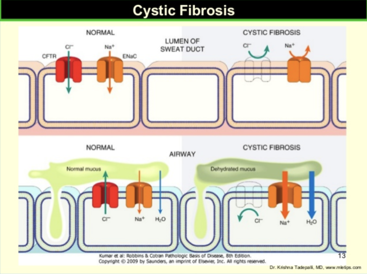 * Genetic mutations cause defect in the CFTR
  * 2000 different genetic mutations identified


* CFTR normally regulates Na+ and Cl- transport across the cell membrane
* Defective CFTR → impaired chloride transport → dehydrated cell surface liquid → mucus plugging → organ dysfunction