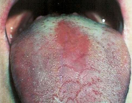 <p>candidiasis causing loss of filliform papilla, anterior to circumcallate papilla</p>
