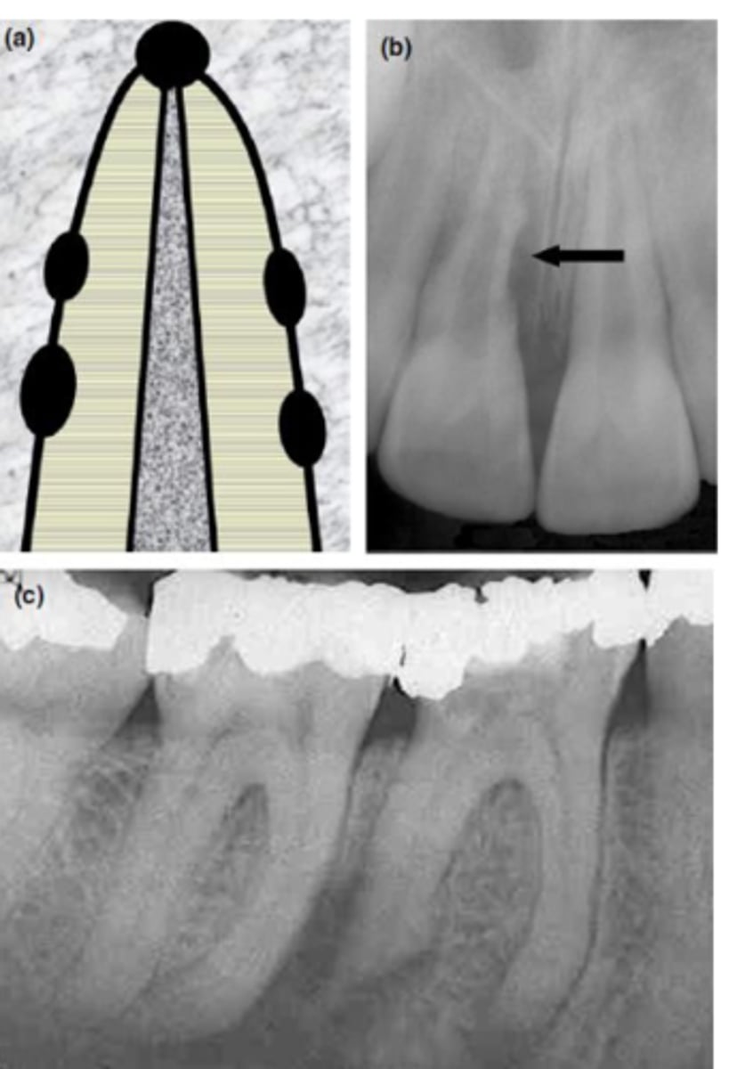 <p>Which type of resorption?</p>