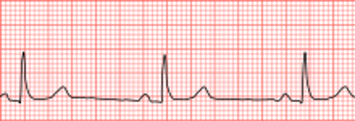 <p>What are the segments of an ECG reading, and what do they represent?</p>