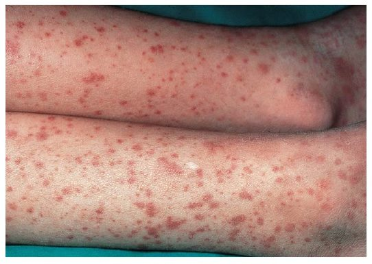 <p><em>Impact on Coagulation</em></p><ul><li><p><strong>Pathophysiology</strong>: Post–upper respiratory infection; <strong>IgA immune complexes</strong> deposit in small vessels</p></li><li><p><strong>Bleeding risk</strong>: Immune-mediated <strong>vasculitis</strong> causes vessel fragility and organ bleeding</p></li><li><p><strong>Clinical signs</strong>: Typically affects <strong>children</strong>; palpable purpura, joint pain, abdominal pain, hematuria/proteinuria</p></li><li><p><strong>Progression</strong>: <strong>Small percentage</strong> may develop <strong>chronic renal disease</strong></p></li><li><p><strong>Coagulation labs</strong>: Usually <strong>normal</strong>; bleeding due to <strong>vascular inflammation</strong>, not factor or platelet defects</p></li></ul><p></p><p>Acquired Vascular Disorder</p><p></p>