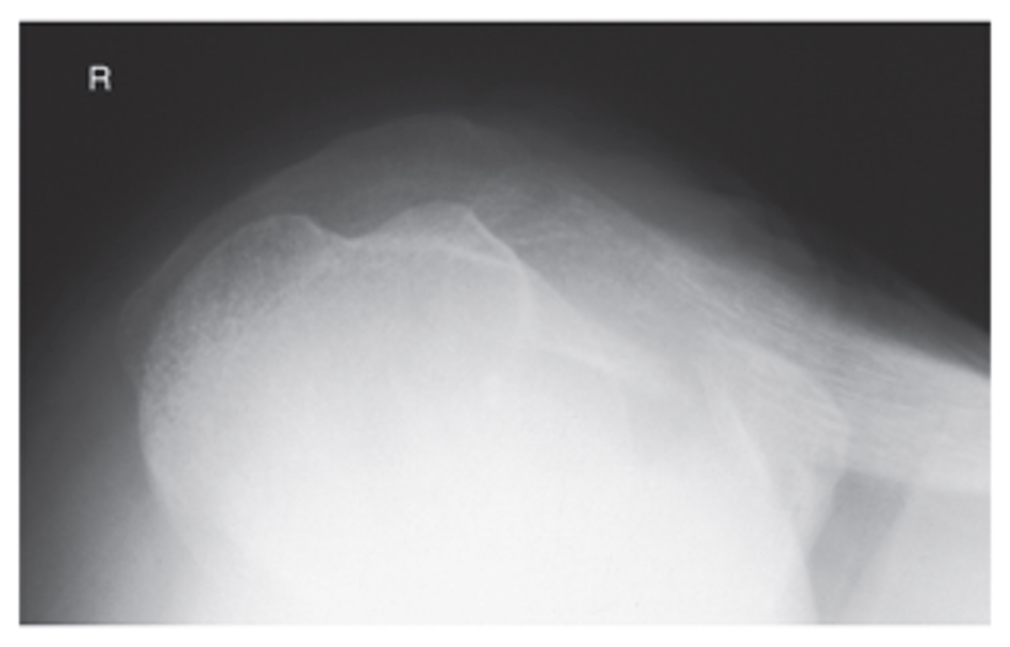 <p>- Anterior humeral head profiled</p><p>- Groove profiled between greater and lesser tubercles</p><p>- Optimal exposure factors</p>