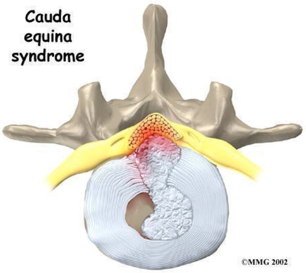 <p>cauda equina syndrome</p>