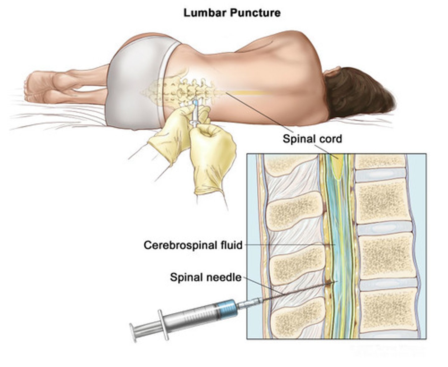 <p>Regional anesthesia includes spinal, in the ____ space ____, or epidural, in the _____. </p>