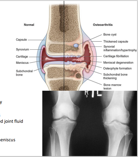 <p>Osteoarthritic cartilage</p><ol><li><p><strong>Articular damage </strong>(trauma, overload, etc)</p></li><li><p><strong>Chondrocytes</strong> eventually <strong>overwhelmed </strong>(breakdown &gt;&gt;&gt; resynthesis)</p></li><li><p>Cartilage slowly eroded<strong>, exposing subchondral bone</strong></p><ul><li><p>Brittle, stiffer, less weight-bearing capacity</p></li></ul></li><li><p><strong>Inflammation</strong></p><ul><li><p>bone will grind to other bone coz cartilage eroded → become bone fragments → inflammation</p></li></ul></li><li><p><strong>Pain </strong>– nerve endings activated by irritants</p><ul><li><p>Distension of synovial capsule by increased joint fluid</p></li><li><p>Microfractures</p></li><li><p>Periosteal irritation</p></li><li><p>Damage to ligaments, synovium, or the meniscus</p></li></ul></li></ol><p></p>