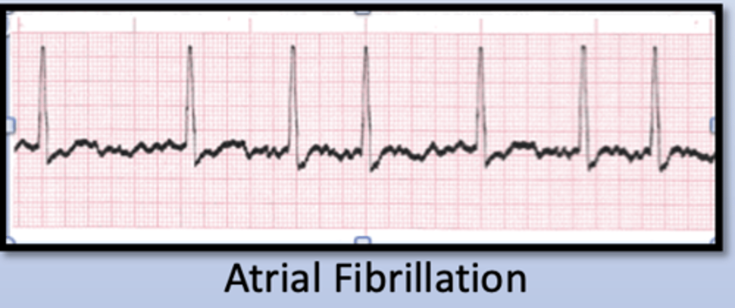 <p>______ Tachycardia: Arrhythmia originating from above the AV node</p><p>- Atrial Fibrillation</p><p>- Atrial Flutter</p><p>- Atrial tachycardia</p>