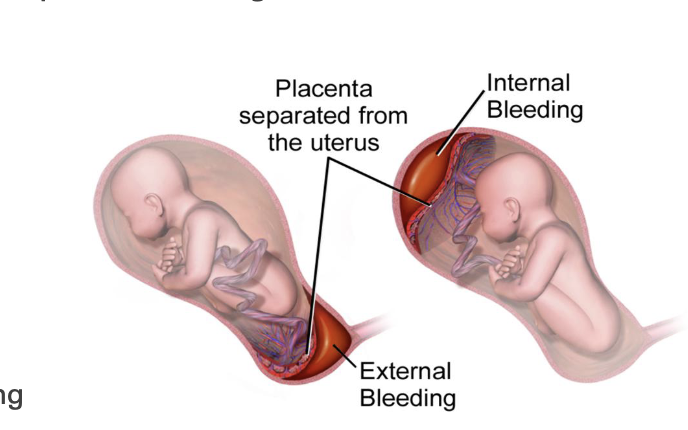 <p>is when the <strong>placenta separates prematurely from the uterine wall</strong> before delivery.</p><p><strong>Risk factors:</strong></p><ul><li><p>HTN disorder, drug use, (meth or cocain), truama, hx of abruption, smoking, PPROM(<strong>Preterm Premature Rupture of Membranes.)</strong></p></li></ul><p><strong>Symptoms</strong></p><ul><li><p>vaginal bleeding,</p></li><li><p>abdominal pain</p></li><li><p>uterine tenderness - localized to specific region</p></li><li><p>contractions - usally requent (blood irritates uterus)</p></li><li><p>fetal distress with increased detachment</p></li></ul><p></p><p></p><p>table</p><table style="min-width: 75px;"><colgroup><col style="min-width: 25px;"><col style="min-width: 25px;"><col style="min-width: 25px;"></colgroup><tbody><tr><th colspan="1" rowspan="1"><p>Feature</p></th><th colspan="1" rowspan="1"><p><strong>Previa</strong></p></th><th colspan="1" rowspan="1"><p><strong>Abruption</strong></p></th></tr><tr><td colspan="1" rowspan="1"><p><strong>Pain</strong></p></td><td colspan="1" rowspan="1"><p>None</p></td><td colspan="1" rowspan="1"><p>Present</p></td></tr><tr><td colspan="1" rowspan="1"><p><strong>Bleeding</strong></p></td><td colspan="1" rowspan="1"><p>Bright red</p></td><td colspan="1" rowspan="1"><p>Dark red</p></td></tr><tr><td colspan="1" rowspan="1"><p><strong>Uterus</strong></p></td><td colspan="1" rowspan="1"><p>Soft</p></td><td colspan="1" rowspan="1"><p>Rigid/tender</p></td></tr><tr><td colspan="1" rowspan="1"><p><strong>Fetal distress</strong></p></td><td colspan="1" rowspan="1"><p>Rare</p></td><td colspan="1" rowspan="1"><p>Common</p></td></tr><tr><td colspan="1" rowspan="1"><p><strong>Delivery</strong></p></td><td colspan="1" rowspan="1"><p>C-section</p></td><td colspan="1" rowspan="1"><p>Often urgent</p></td></tr></tbody></table><p></p>