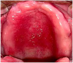 <p>inflammatory condition of the oral mucosa that occurs in denture wearers, characterized by redness, swelling, and soreness of the tissues beneath the denture</p>