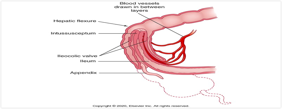 <p>-<strong>Telescoping of a proximal segment of intestine into a distal segment, causing an obstruction</strong></p><p>-<strong>The most common scenario is the ileum telescopes into the cecum and part of the ascending colon by collapsing through the ileocecal valve</strong></p><p>-<strong>Causes bleeding, necrosis, and bowel perforation if not treated</strong></p><p></p>