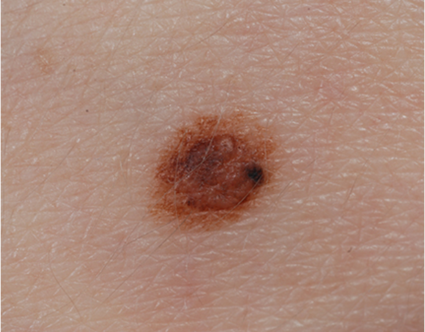 <p>what condition?</p><ul><li><p><strong>precursor of malignant melanoma</strong></p></li><li><p>benign AMN w/ asymmetric irregular borders, </p></li><li><p>variegated colors- pink, tan, brown</p></li><li><p>diameter &gt; 5mm</p></li><li><p>macular component w/ papular center → <strong>fried egg appearance</strong></p></li></ul><p></p>