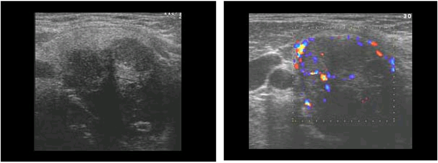 <p>malignant</p><p> associated with primary hyperparathyroidism</p><p>↑ PTH ↑ Calcium</p>